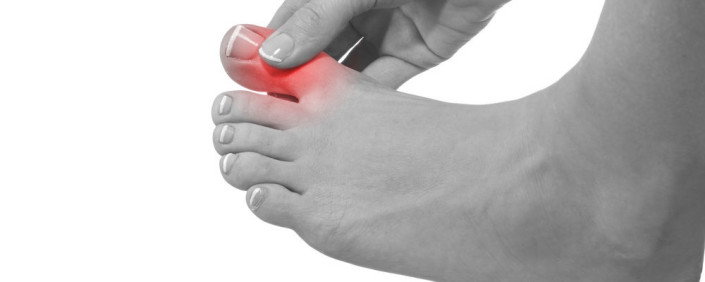 Hallux Limitus St Louis Podiatry Stiff Toe Joint Treatment